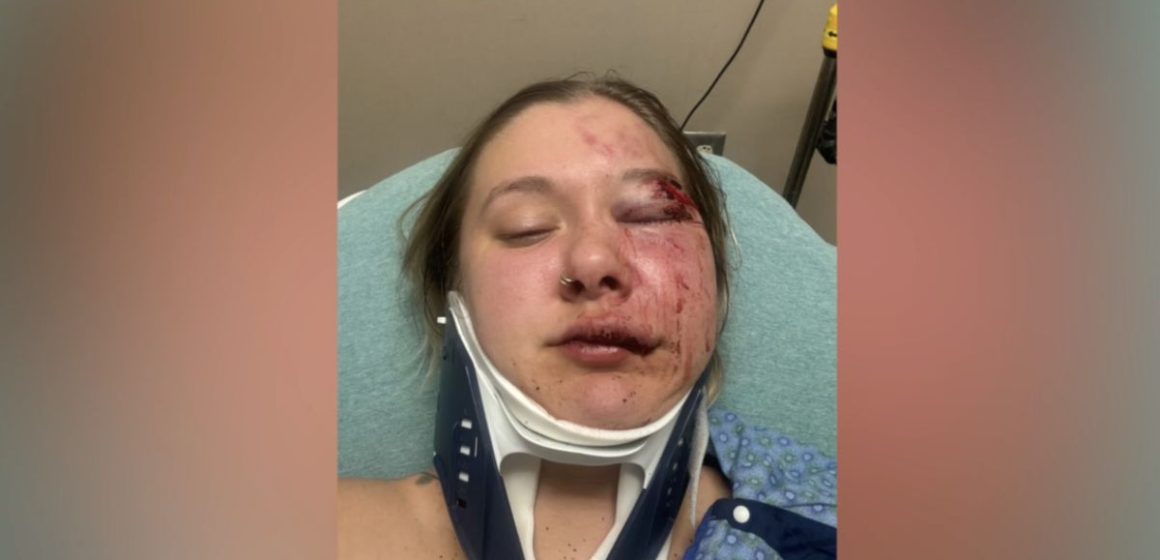 Detroit Assault Mount Clemens Woman Brutally Beaten After Night Out