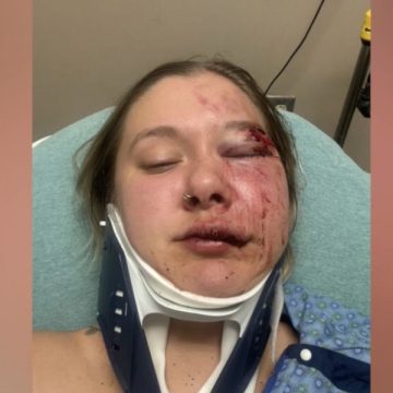 Detroit Assault Mount Clemens Woman Brutally Beaten After Night Out